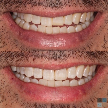 photos of smile before and after dental work