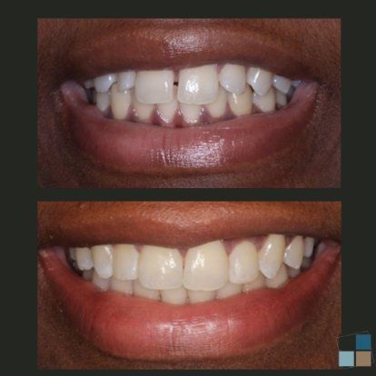 photos of smile before and after dental work