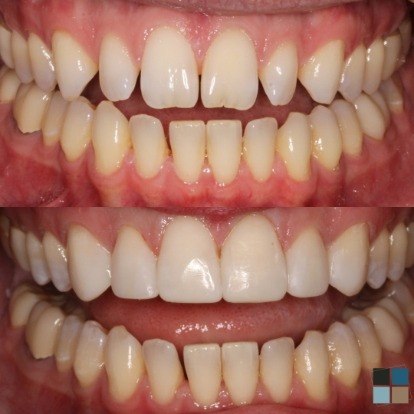 photos of smile before and after dental work