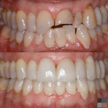 photos of smile before and after dental work