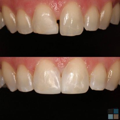 photos of smile before and after dental work