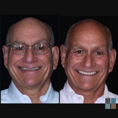 photos of smile before and after dental work