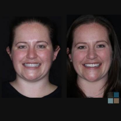 photos of smile before and after dental work