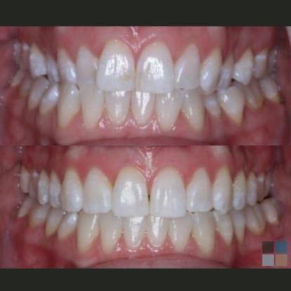 photos of smile before and after dental work