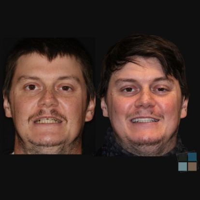 photos of smile before and after dental work