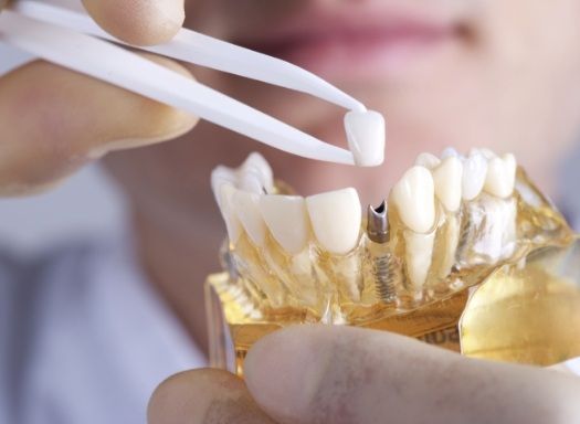 Dental crown being placed on model of mouth with dental implant