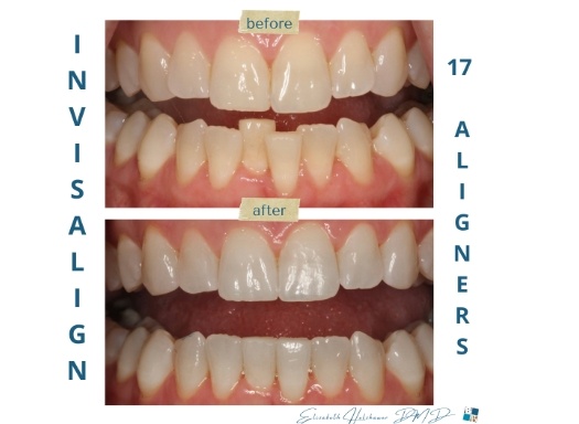Close up of smile before and after straightening teeth with Invisalign