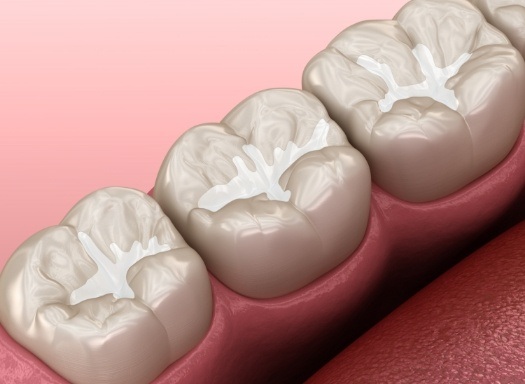 Illustrated row of teeth with barely noticeable tooth colored fillings