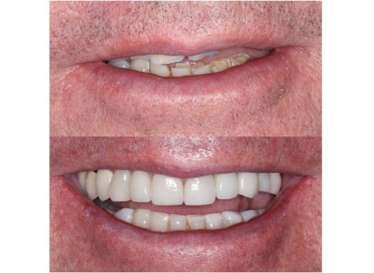 Close up or smile before and after full mouth reconstruction