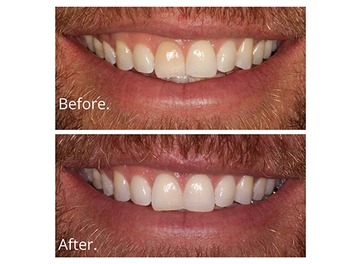 Close up of smile before and after teeth whitening